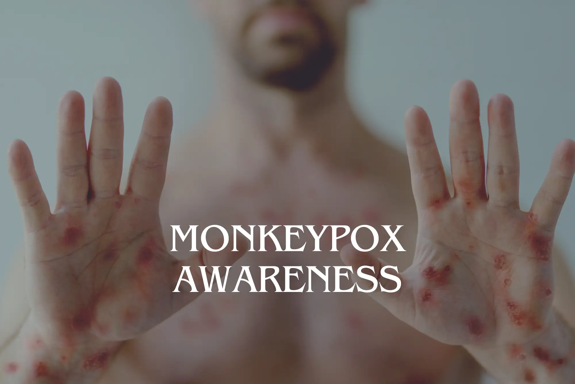 Monkeypox Awareness