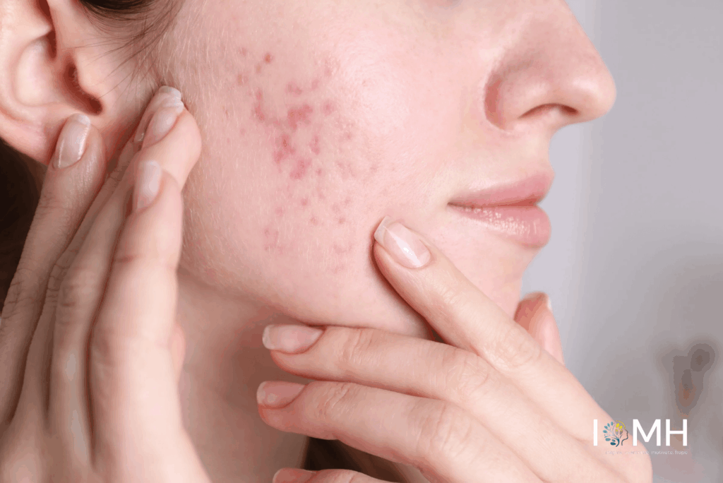 Close-up of a woman’s cheek showing acne and red blemishes while gently touching her skin during natural skincare care